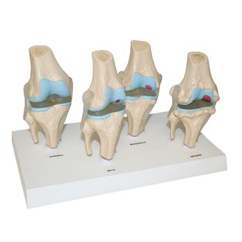 4 Stages of Knee Joint Diseases Model