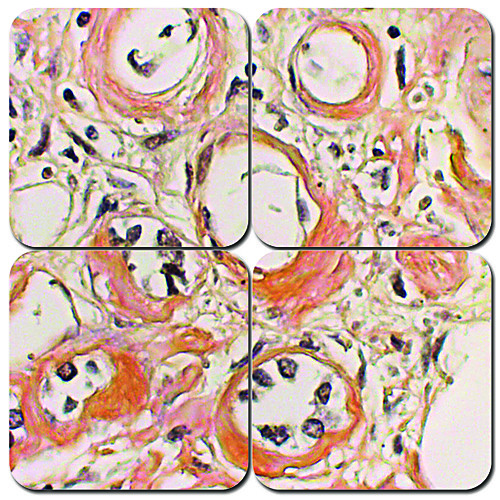 Congo Red Amyloid Stain Kit