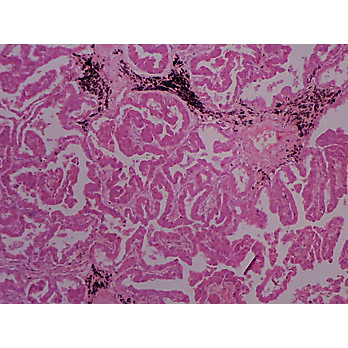 Prepared Microscope Slide,Adenocarcinoma of the Lung